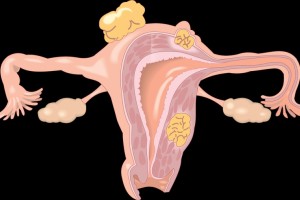 云南白药治疗子宫肌瘤怎么样得了子宫肌瘤该如何调养